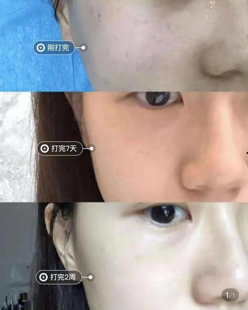 明星做光子嫩肤吗,揭秘光子嫩肤的神奇魅力